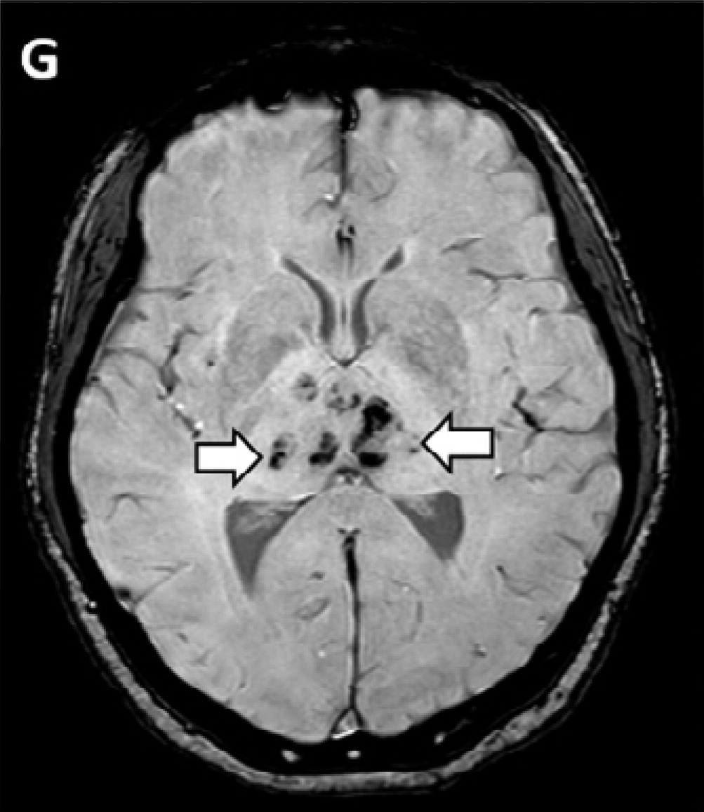 МРТ-изображения головного мозга в двухсторонних медиальных височных долях и талами