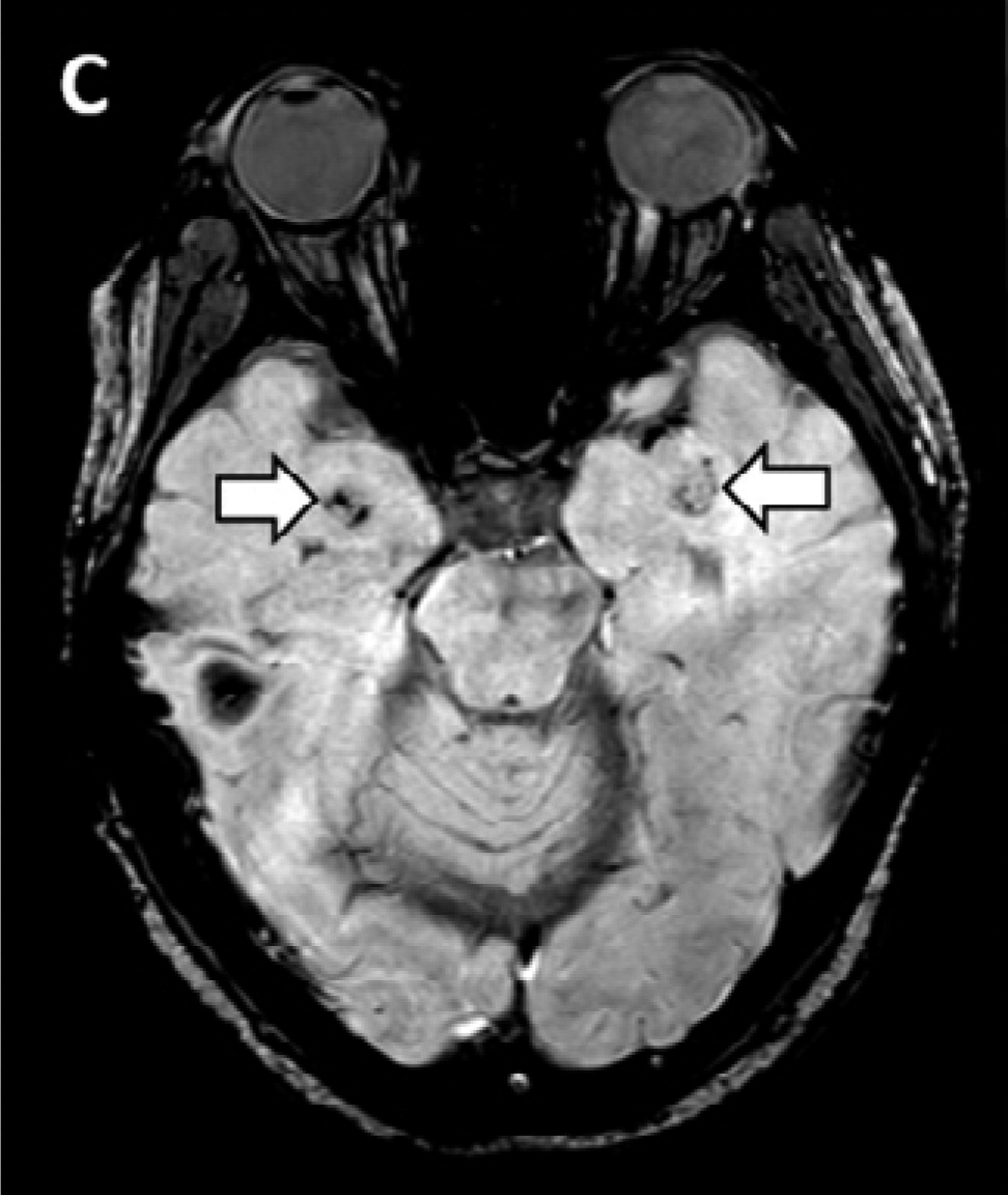 МРТ-изображения демонстрируют гиперинтенсивность T2 FLAIR 