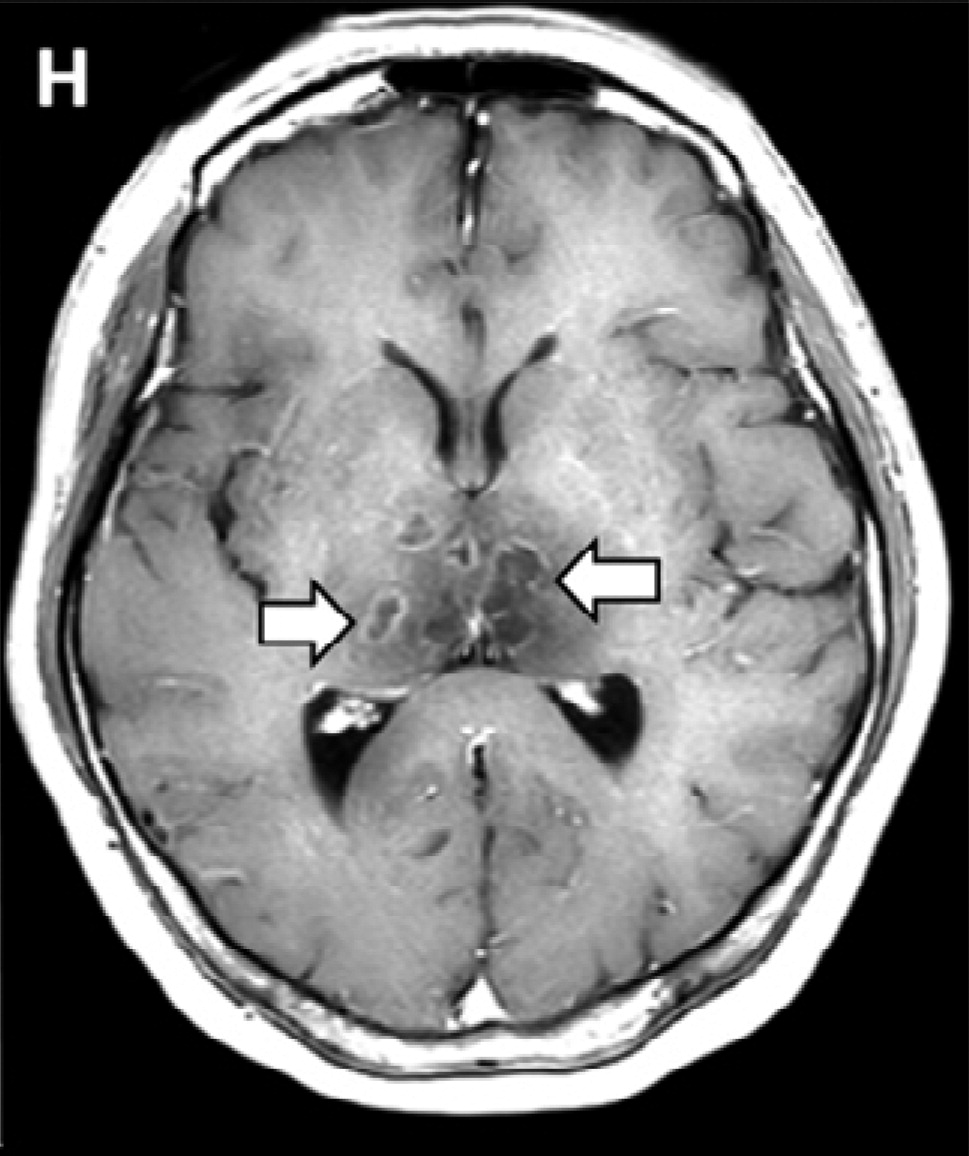 МРТ-изображения головного мозга в двухсторонних медиальных височных долях